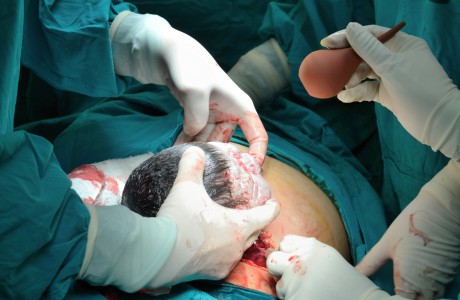 נ’ מטופלת שהגיעה לאחר ניתוח קיסרי עם חתך שהזדהם